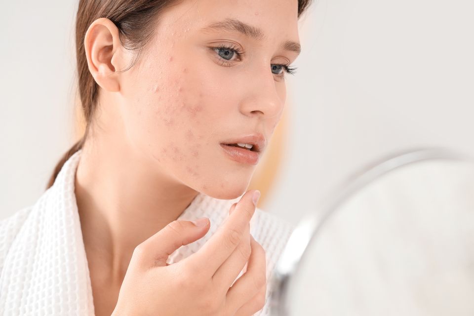 Comment reconnaître une acné hormonale chez la femme ?
